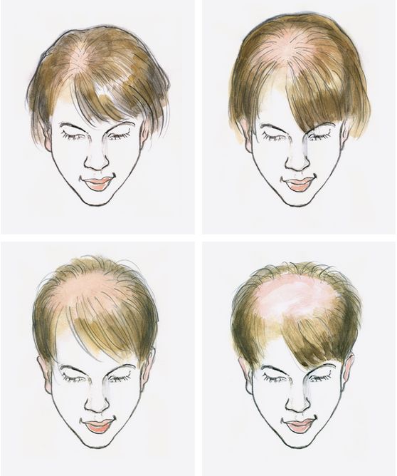 Genetisch bedingter Haarausfall bei Frauen 
