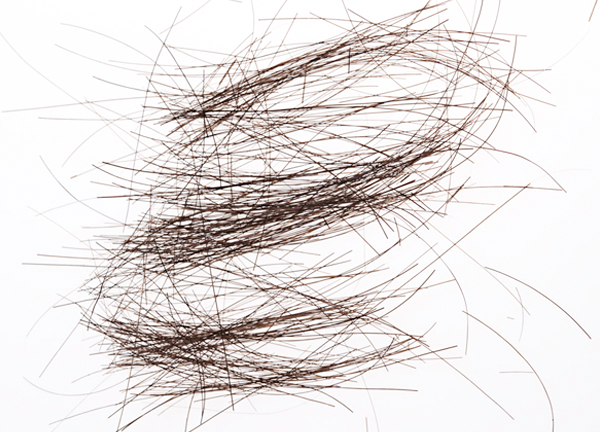 schmererderfriseur_haarausfall_vernarbenderHaarausfall_copyright_angelikasalomon Vernarbender Haarausfall